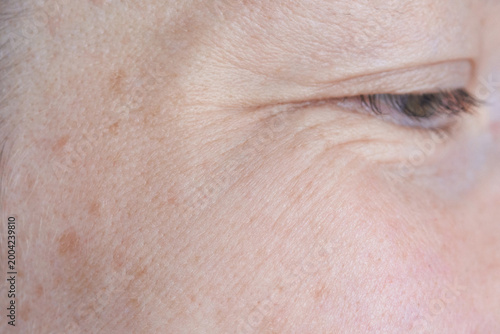 Schilderij op canvas Outer Eye Area Showing Crow Feet Wrinkles And Age Spots In Close Up Clinical View On Temple And Cheek Under Neutral Soft Lighting For Dermatologic Evaluation