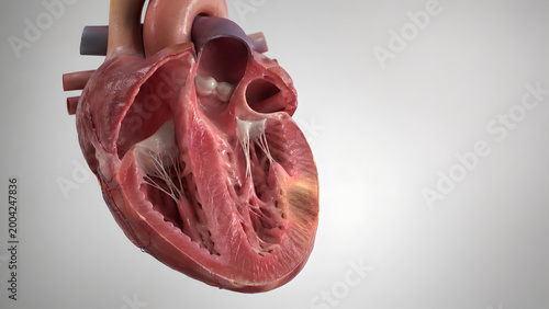 Cutaway human heart, chambers, myocardium, coronary vessels, focal highlight in left ventricular wall, localized myocardial injury, ischemia