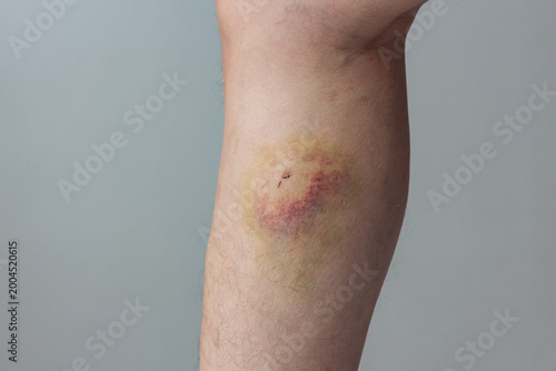 Obraz na plátne Close-up of a large yellow and purple bruise on a man's leg and abrasion on his leg from an injury