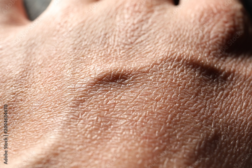 Fototapeta premium Man with dry skin on his hand, closeup