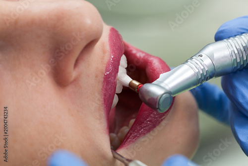 Professional dental brushing