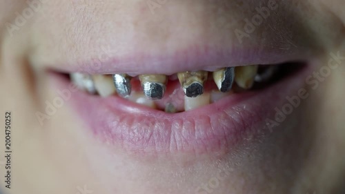Close-up of smiling mouth with dental implants. Extreme close-up of a smiling mouth showing dental implant posts ready for crown placement, highlighting implantology and restorative dentistry