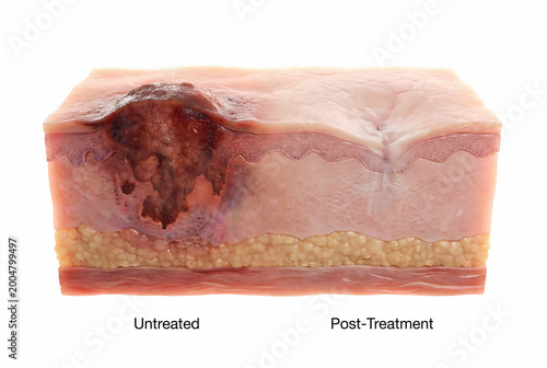Skin cancer cross section showing untreated lesion and healed tissue