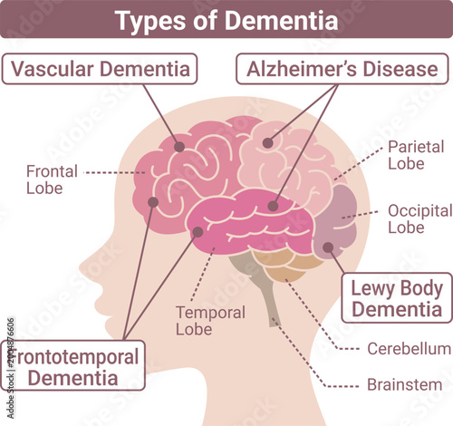 Dementia types brain diagram side view flat