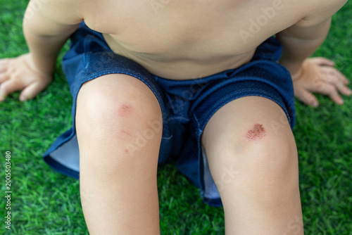 Quadro su tela Child with scraped knees showing red abrasion wounds sitting on green grass outd