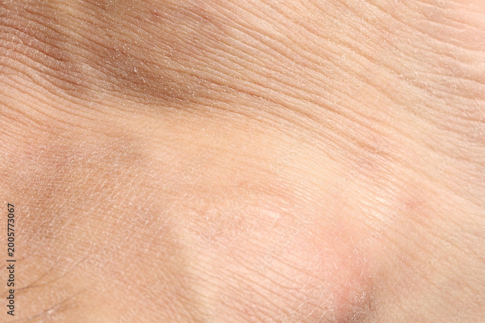 Fototapeta premium Texture of dry skin as background, closeup