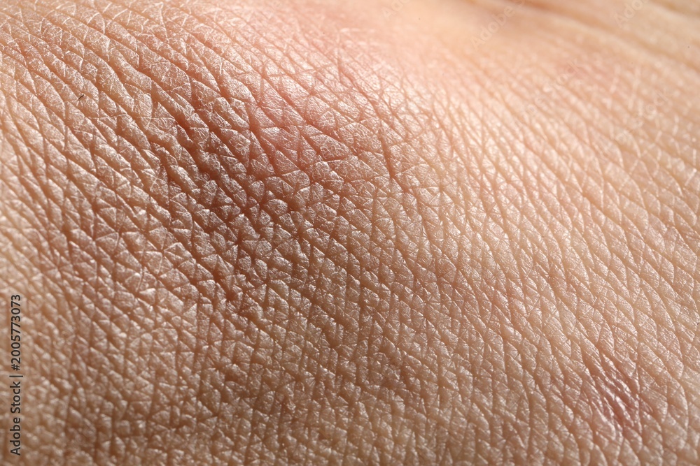 Fototapeta premium Man with dry skin on his hand, closeup