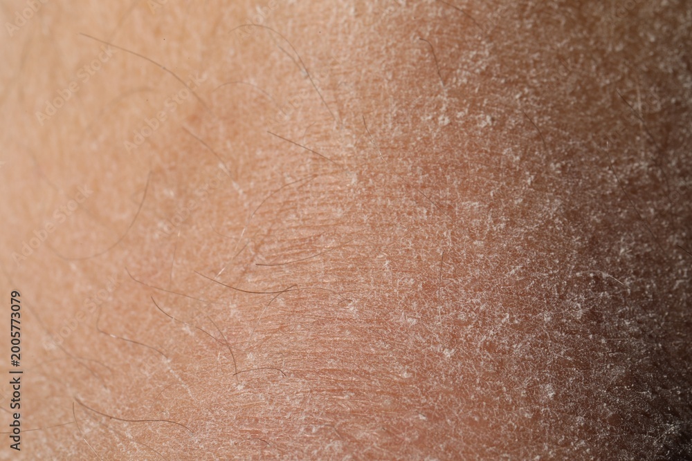 Fototapeta premium Texture of dry skin as background, closeup