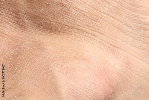 Foto Texture of dry skin as background, closeup