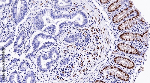 Colon Cancer Microsatellite Instability MMR Protein IHC
