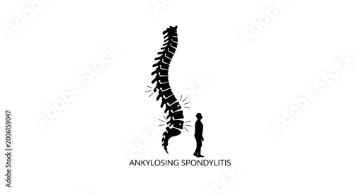 Foto Medical illustration of Ankylosing Spondylitis with silhouette of spine and human