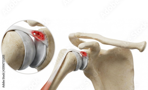 SLAP Lesion. Accurate Medically Illustration of Superior Labrum Tear at the Biceps Tendon Anchor. Labeled