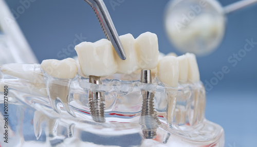 Dental implantology and prosthetics concept. Tweezers placing a ceramic bridge on titanium implants in a transparent jaw model.