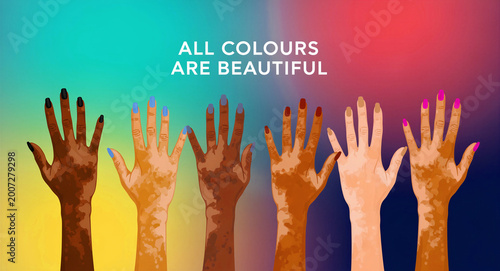 Diverse hands with vitiligo and colorful nails reaching up. Illustration of various skin tones with inspirational text on a gradient. Diversity concept for skin positivity and social awareness.