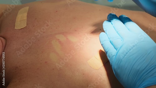 Surgeon removes moles with laser coagulation from man skin in clinic slow motion. Doctor with modern instrument treats patient birthmarks in hospital
