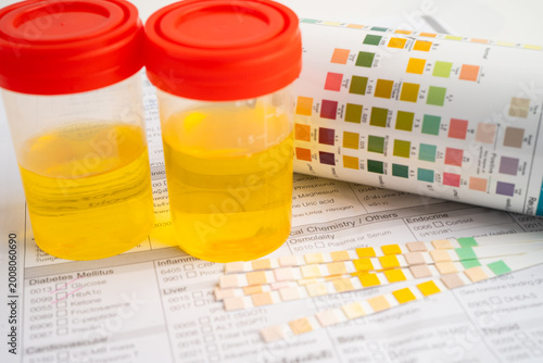 Bild auf Leinwand Urinalysis, urine cup with reagent strip pH paper test and comparison chart in laboratory