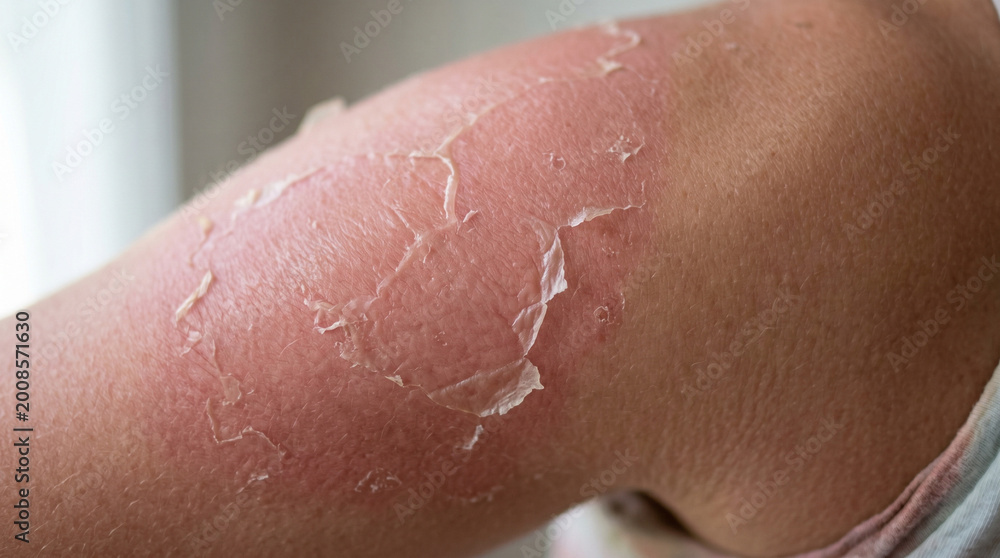 Fototapeta premium Close-up of peeling skin on shoulder after sun exposure concept of Summer skincare