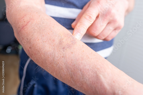 Close up of several red scratches on an adult male's forearm, skin irritation and minor injury caused cat, plants, Physical injury and skin trauma, Dermatological irritation, Pet ownership challenges