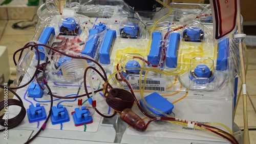Medical apheresis machine used for bone marrow transplantation procedure in hospital laboratory