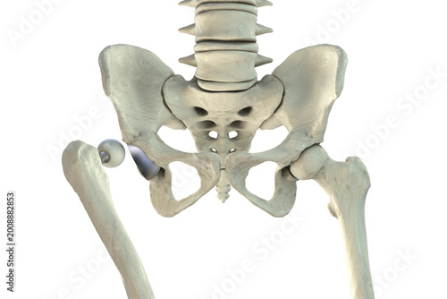 Posterior dislocation of total hip replacement, 3D illustration showing posterior displacement of the prosthetic femoral head from the acetabular component, isolated medical depiction