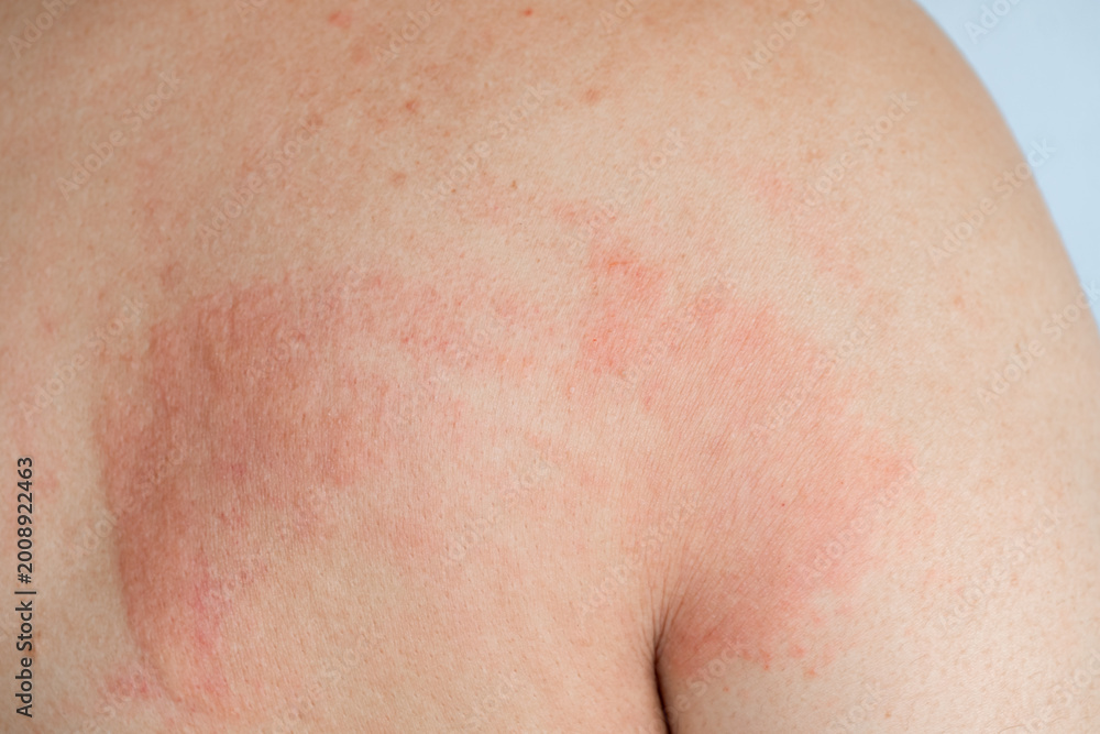 Fototapeta premium Close up of a man with a red skin rash and inflammation on his back. A person scratching an itchy allergic reaction, eczema, or dermatitis on the body. Concept of healthcare and dermatology, urticaria