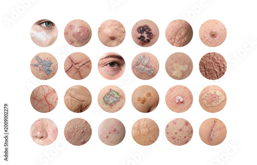 Collection of various skin conditions and dermatological symptoms, ai generated. Detailed dermatology collage multiple skin problems with irritation, dryness, inflammation and texture changes.