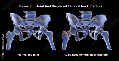 Normal hip joint and displaced femoral neck fracture, 3D illustration