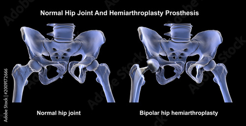 Фотография Normal healthy hip joint with intact femoral head, and acetabulum, and bipolar hemiarthroplasty prosthesis with dual mobility femoral head and femoral stem, 3D illustration