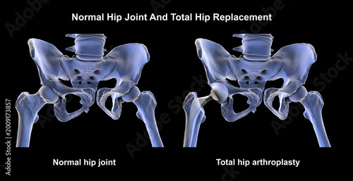 Принти на полотні Normal healthy hip joint with intact femoral head, acetabulum, articular cartilage and joint space, and total hip replacement, 3D illustration
