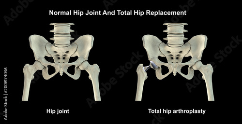 Foto Normal healthy hip joint with intact femoral head, acetabulum, articular cartilage and joint space, and total hip replacement, 3D illustration