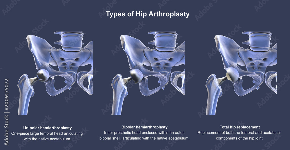 Fototapeta premium Three types of hip prostheses: unipolar hemiarthroplasty, bipolar hemiarthroplasty and total hip replacement, 3D illustration
