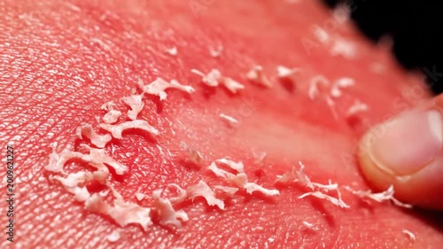 Close up of a finger touching peeling sunburnt skin