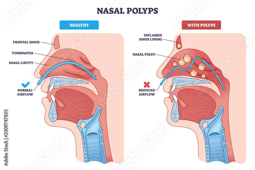 Photos Nasal polyps brief overview showing healthy vs polyp-filled sinuses, with airflow arrows illustrating obstruction, key elements, nasal cavity, polyps, inflamed lining