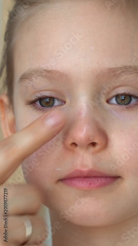 Close up of hand applies ointment to child face with atopic dermatitis. Portrait of girls face with allergy. Diathesis. Vertical shot