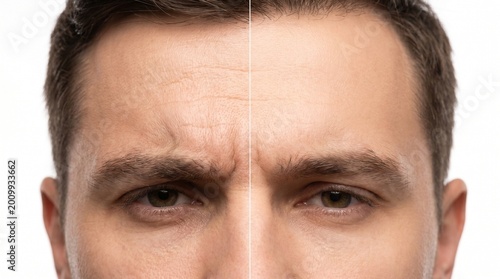 Man's forehead before and after anti-aging wrinkle removal procedure