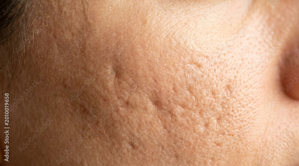 Fototapeta premium Close-up cheek with acne scars and uneven skin texture on neutral background with copy space words + concept