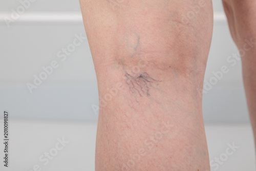 Foto Woman leg showing spider veins on skin