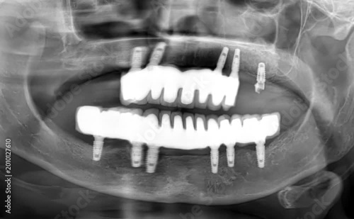 Dental panoramic radiograph showing multiple dental implants and prosthetics. Full jaw x-ray highlighting complex restorative dentistry clinical case for surgical education and patient consultation.