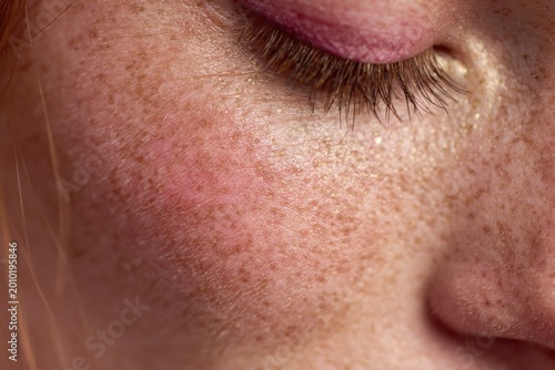 Close up of a womans cheek showing freckles and redness.