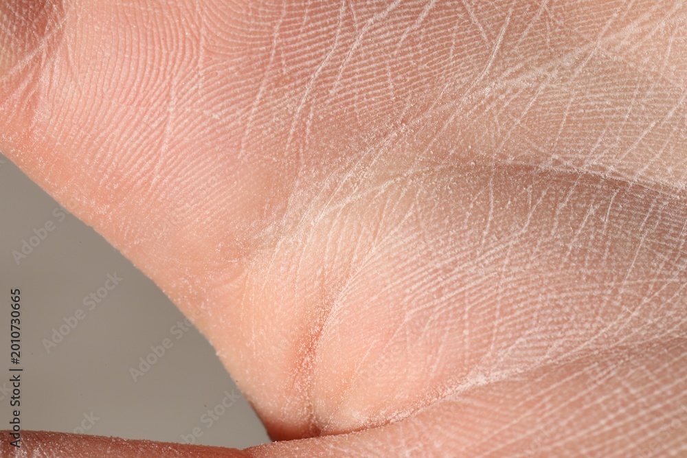 Fototapeta premium Man with dry skin on his hand against grey background, closeup