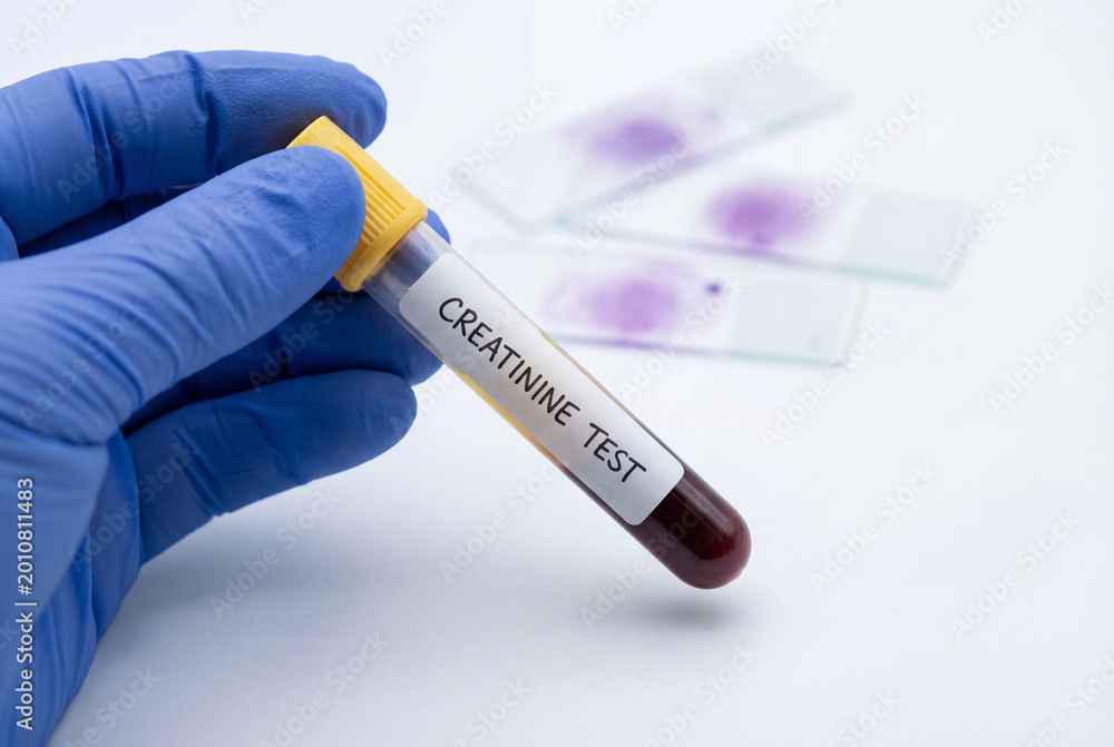 Obraz premium Hand in blue glove holding creatinine blood test sample tube