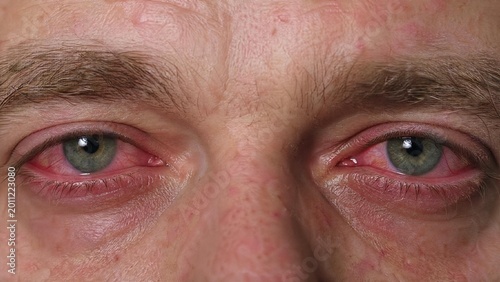Close-up of Red Bloodshot Eyes with Conjunctivitis or Allergic Reaction