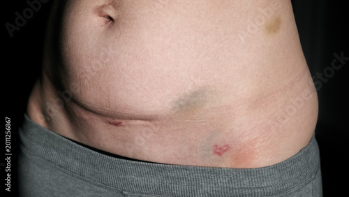 Fresh medical scars on female abdomen after laparoscopic surgery. Stretch marks on light caucasian skin after cesarean section on dark background. Body Lymphatic edema. Maternity concept. Front view.
