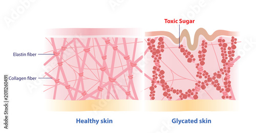 Foto Comparison of healthy and glycated skin illustration