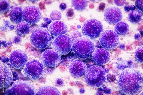 Photomicrograph depicting acute leukemia cells in marrow aspirate for medical awareness