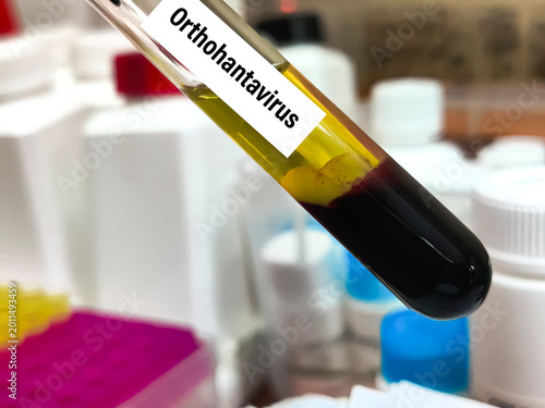 Schilderij op canvas Biological Specimen blood test for detecting IgM and IgG antibodies (ELISA) or molecular PCR tests to detect viral RNA of Orthohantavirus or Hantavirus
