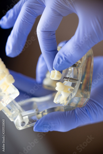 Transparent dental typodont model showing tooth roots and metal implant pin demonstrated by dentist illustrating implant placement structure dental anatomy and modern implantology training