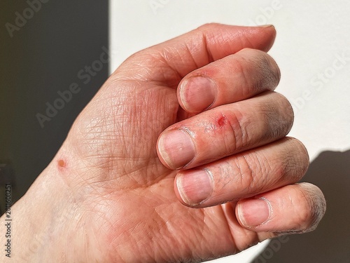 Vászonkép A close-up view of a healing burn on a woman's hand in natural light