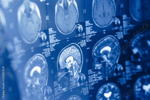Medical imaging displays brain scans showing various sections of the human brain for analysis and review in a clinical setting