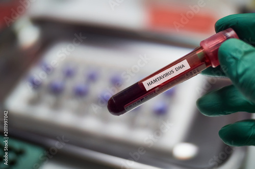 An epidemiologist holds a vial containing a sample for hantavirus virus HTNV analysis in a laboratory